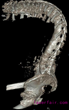 X射線下顯示吳先生脊柱已嚴重彎曲
