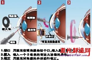 英激光新技術(shù)校正老花眼